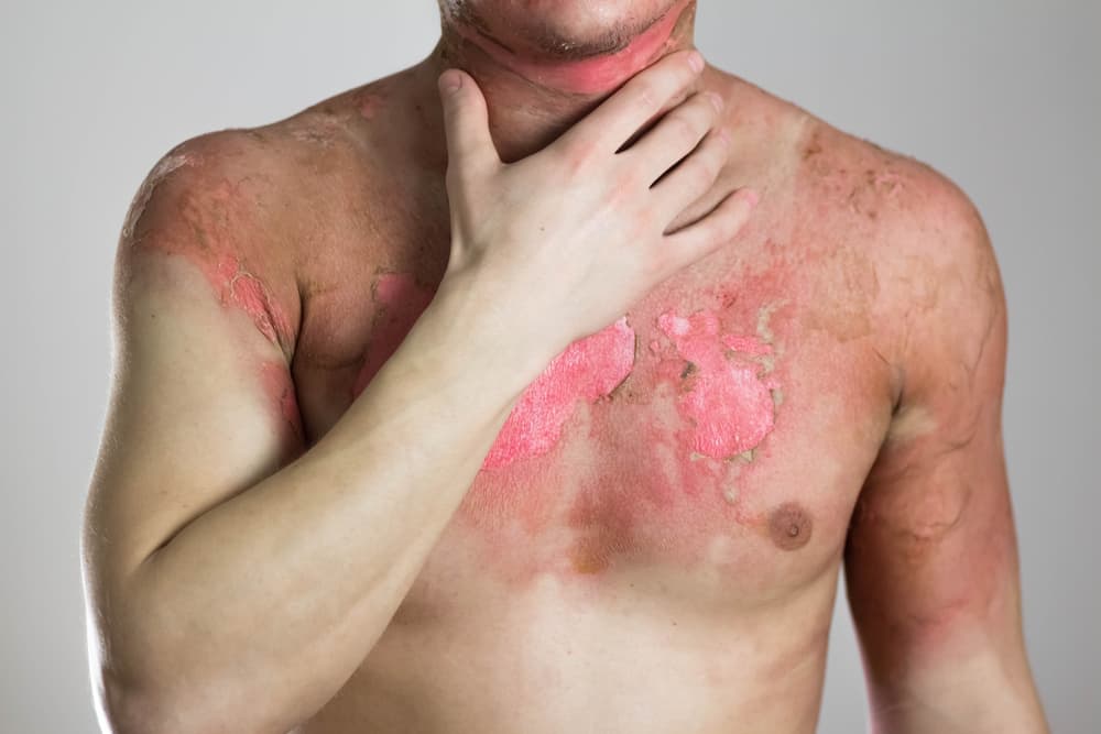 person with burn marks al over body